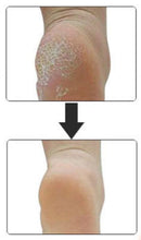 Load image into Gallery viewer, Heel Spur Relief - Plantar Fasciitis Gel Cup Massage Pads