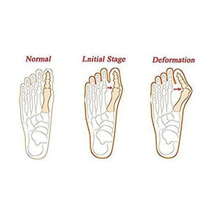 Bunion Splint Wrap - Corrector Brace ~ Big Toe Straightener